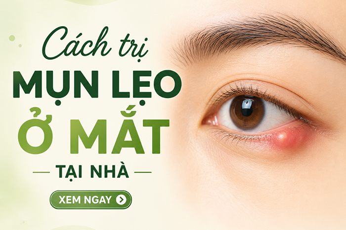 Cách trị mụn lẹo ở mắt nhanh khỏi nên áp dụng ngay