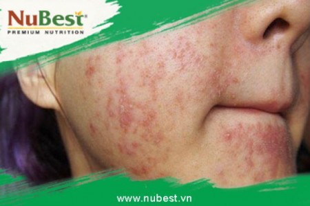 Cách trị mụn tuổi dậy thì an toàn hiệu quả