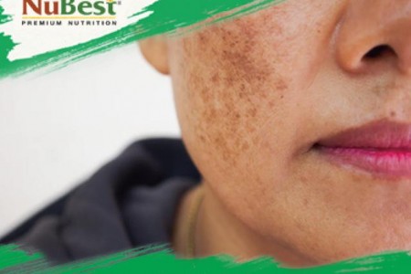 Tổng hợp cách trị nám da đơn giản tại nhà