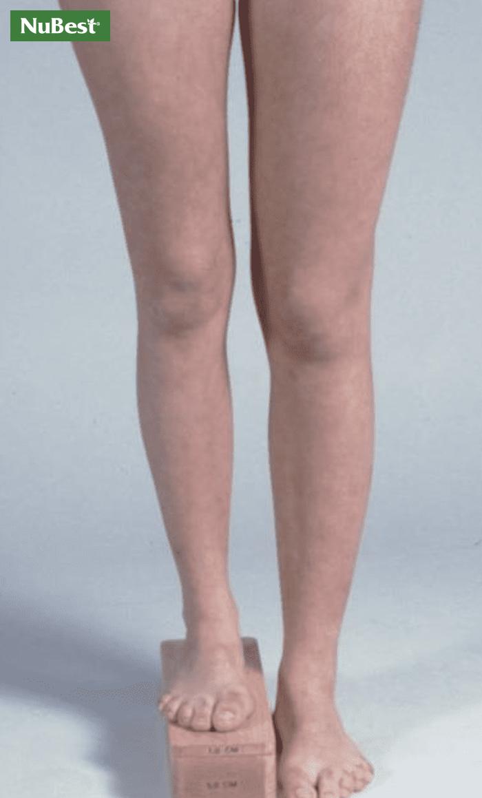 Biến chứng chân dài chân ngắn khi phẫu thuật kéo dài chân