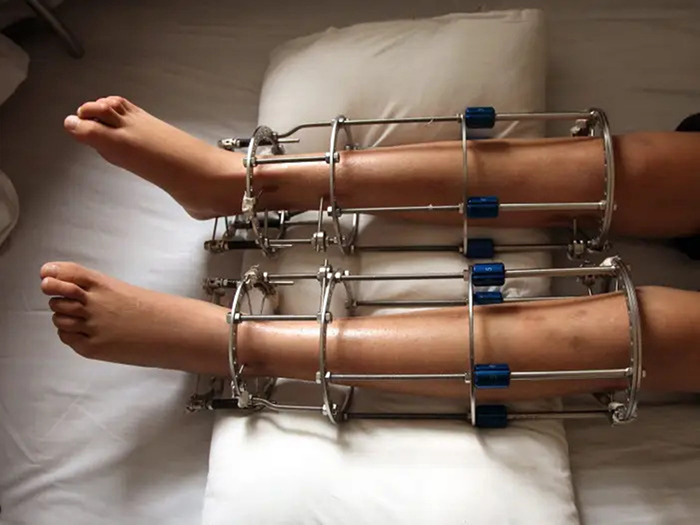 Phẫu thuật kéo dài xương với nhiều rủi ro nguy hiểm