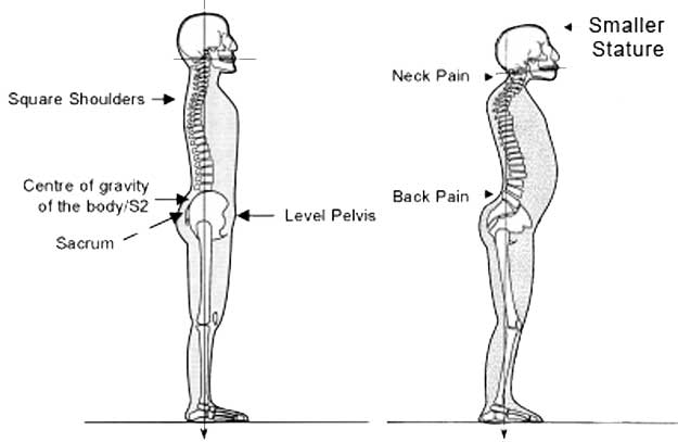 tư thế xấu làm chiều cao của bạn giảm xuống