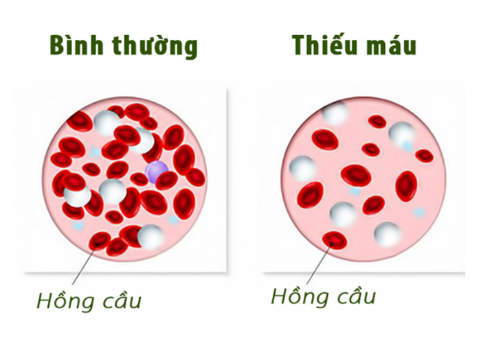 Tỷ lệ hồng cầu trong cơ thể người bình thường và người mắc bệnh thiếu máu.