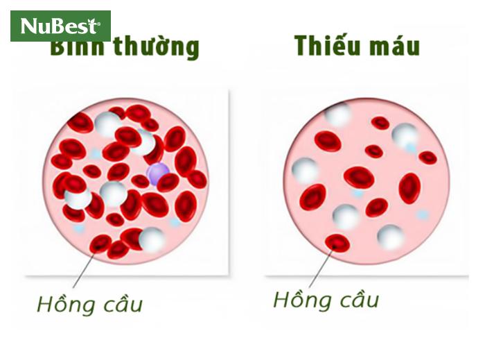 Tỷ lệ hồng cầu trong cơ thể người bình thường và người mắc bệnh thiếu máu.