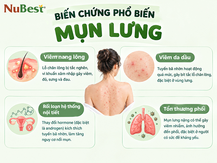 Trị mụn lưng sớm để tránh các biến chứng nguy hiểm.