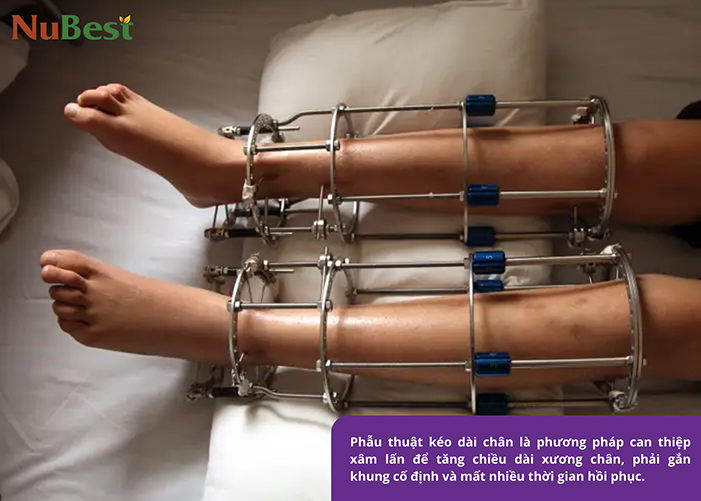 Phẫu thuật kéo dài chân là cách tăng chiều cao nhanh nhưng rủi ro