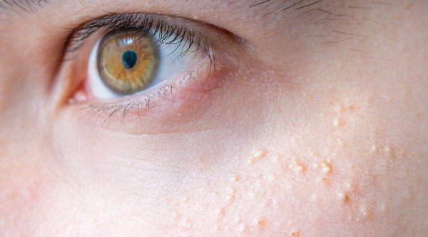 Mụn đá thực chất là u tuyến mồ hôi do sự lắng đọng keratin