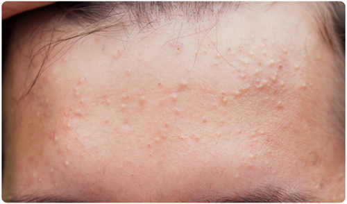 Thói quen sinh hoạt không khoa học làm tăng nguy cơ bị mụn đầu trắng