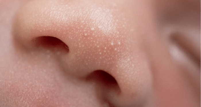 Mụn đầu trắng là loại mụn li ti, có đầu màu trắng thường mọc ở mũi, cằm, trán