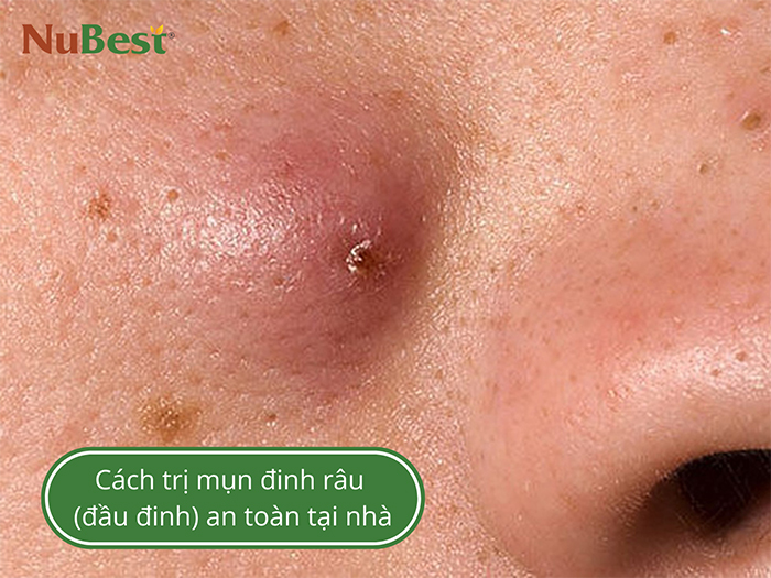 Mụn đinh râu chứa mũ và khiến bạn đau nhức