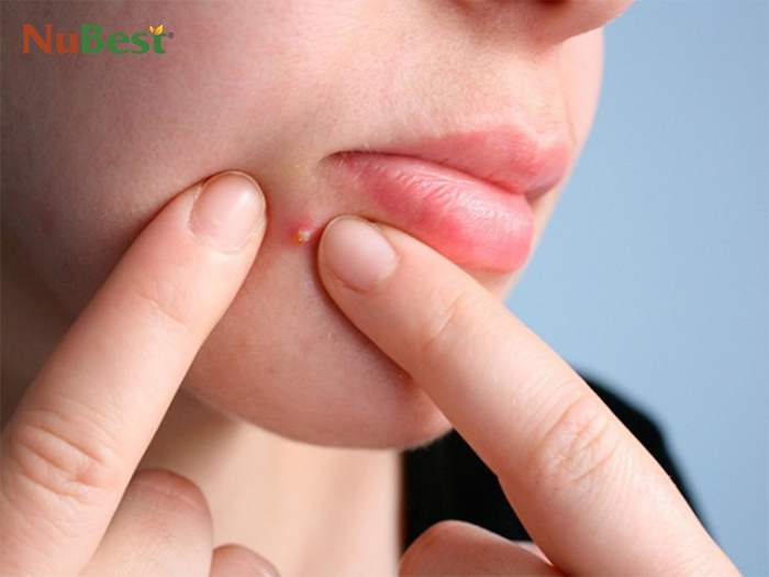 Mụn đinh râu khi bước vào giai đoạn 2