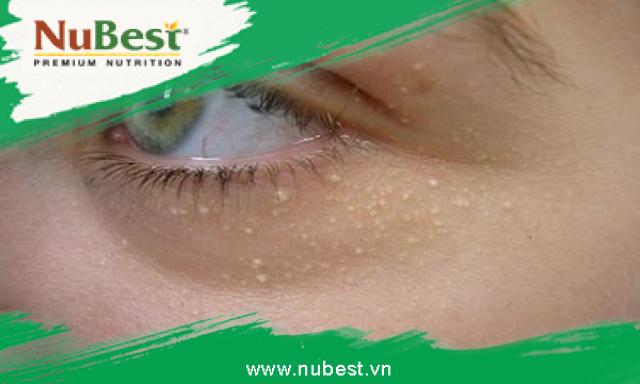 Mắt là vùng da thường xuất hiện mụn gạo nhất
