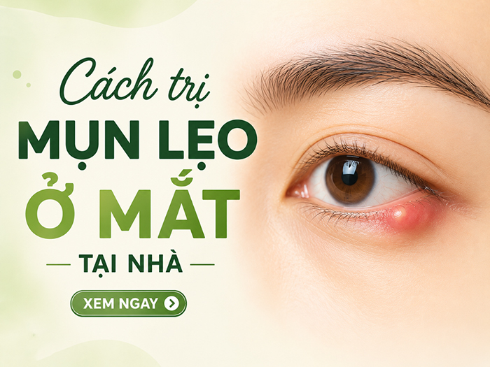Tham khảo các cách trị mụn lẹo có thể thực hiện tại nhà.