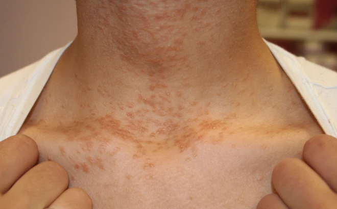 Mụn mọc ở cổ khiến nhiều người cảm thấy tự ti