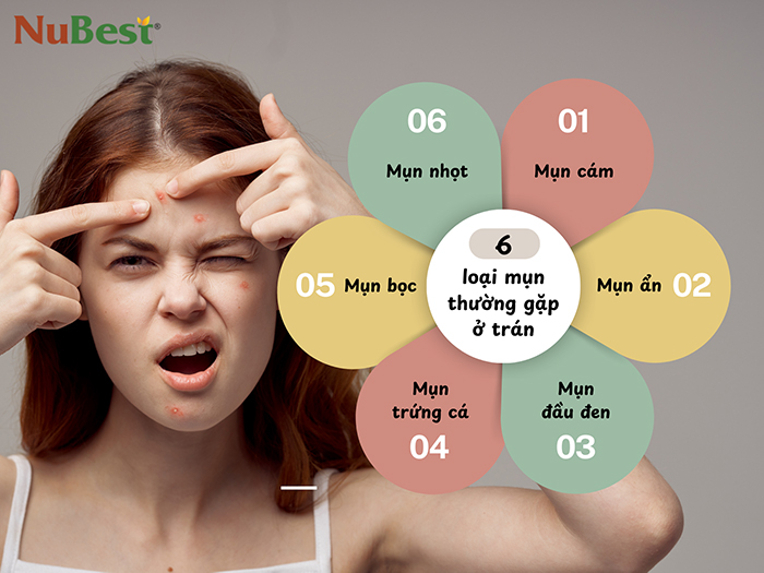 Các loại mụn thường gặp ở trên trán