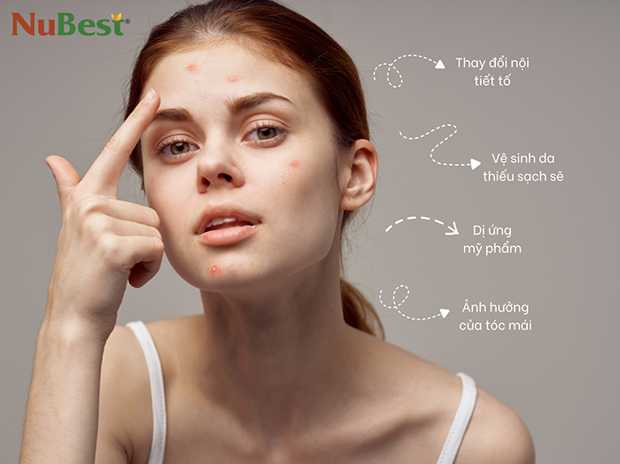 Mụn xuất hiện ở trán do nhiều nguyên nhân khác nhau