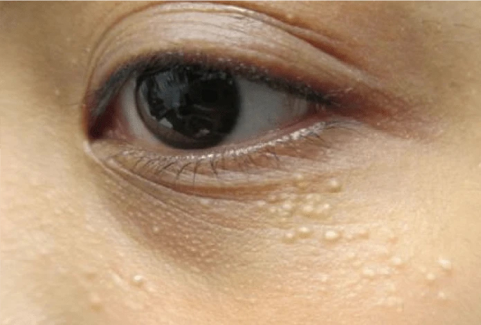 Mụn thịt có kích thước nhỏ, không viêm, không đau&nbsp;