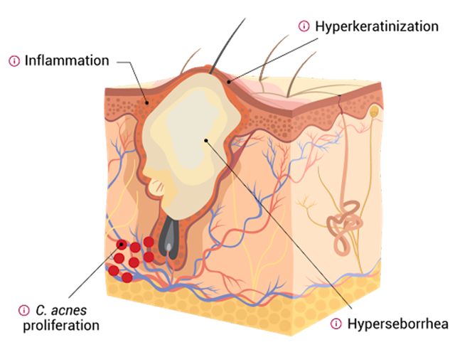 Cấu trúc bề mặt của nốt mụn bên dưới da
