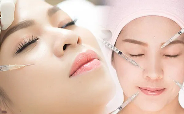 Tiêm filler xóa nếp nhăn hai bên mũi