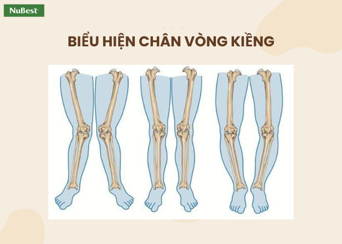 Những biểu hiện của chân vòng kiềng ở trẻ, cha mẹ cần nắm 