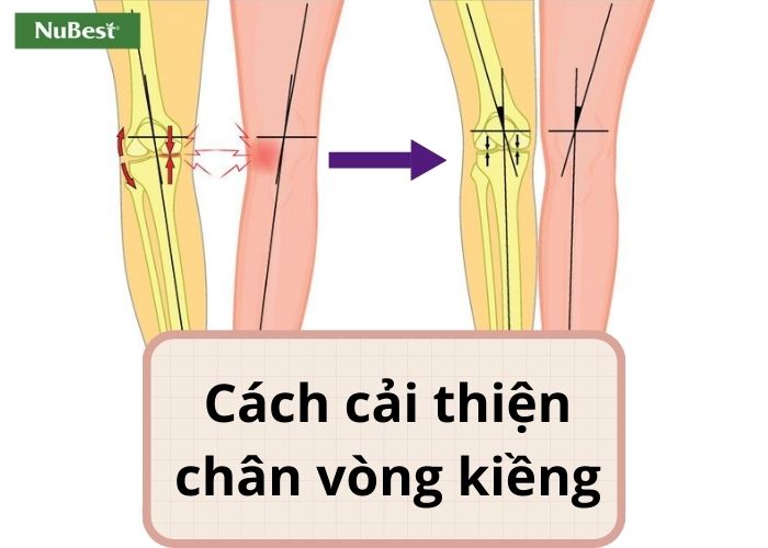 Các biện pháp điều trị chân vòng kiềng hiệu quả