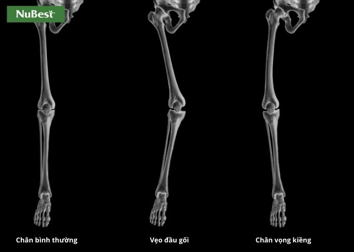 Chân vòng kiềng có khớp gối hướng ra ngoài, xương chân cong