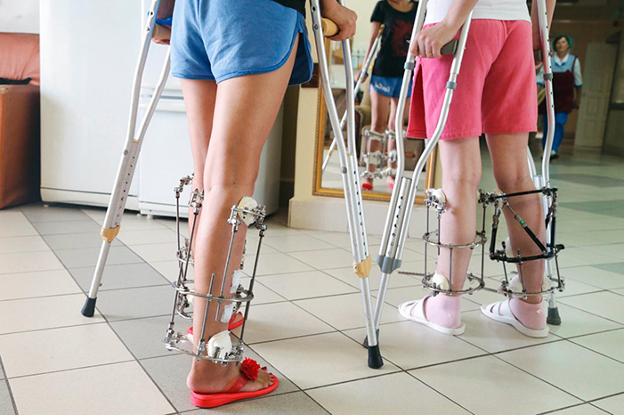 Phẫu thuật kéo dài chân rất đau đớn và nhiều rủi ro