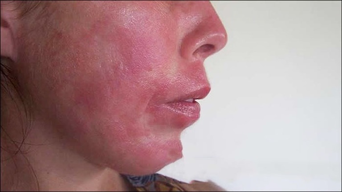 Hình ảnh da mặt bị dị ứng thời tiết có dấu hiệu viêm