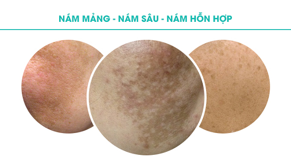 Hình ảnh các loại nám da ở nam giới