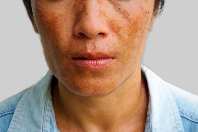 Nám da ở nam là tình trạng xuất hiện một số vùng da sạm màu hơn các vùng da còn lại