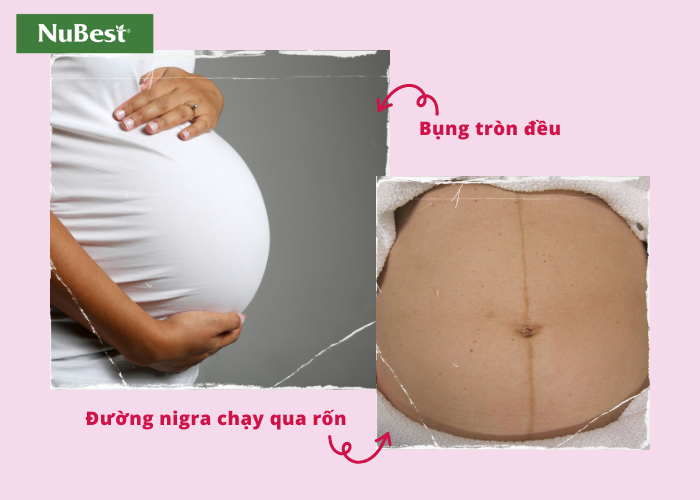 Mang thai con gái thường có phần bụng tròn đều và đường nigra chạy thẳng qua rốn
