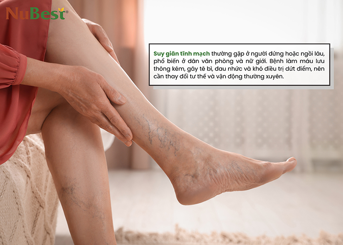 Suy giãn tĩnh mạch là vấn đề thường gặp khi phải đứng quá nhiều