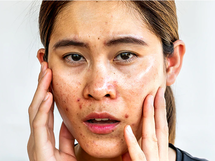 Nếu không chăm sóc kỹ lưỡng, làn da dầu rất dễ nổi mụn và có lỗ chân lông to