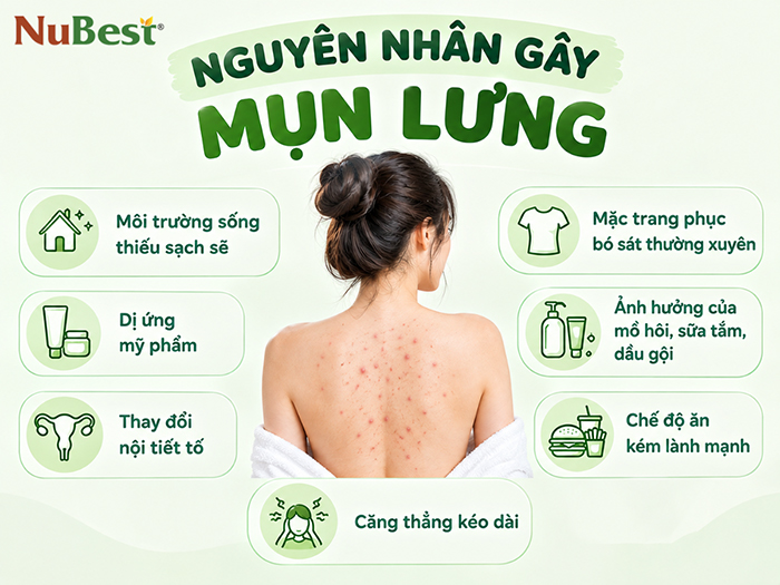 Nguyên nhân phổ biến gây mụn lưng.