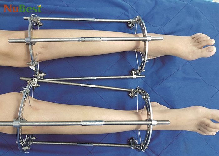 Phẫu thuật kéo dài chân cần nhiều thời gian để hồi phục