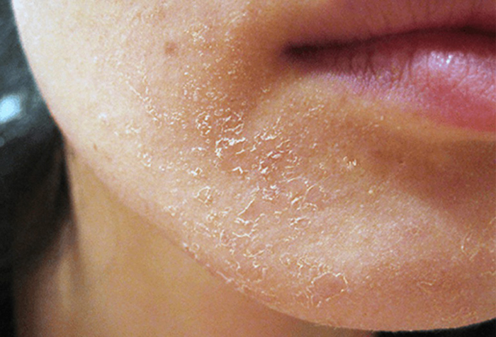 Da mặt bị lột gây đau rát, khó chịu, nhất là vào mùa đông