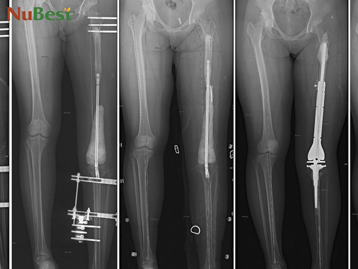 Phẫu thuật kéo dài xương rất đau đớn và nhiều rủi ro