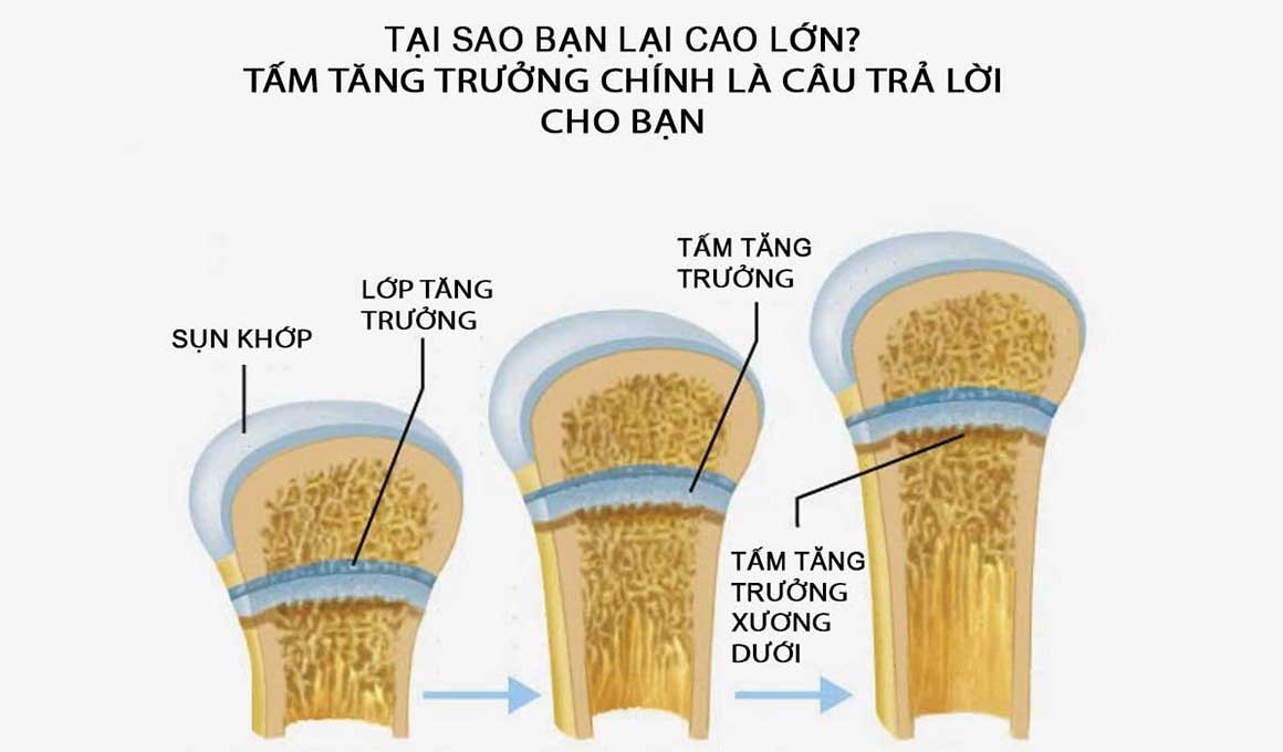 Tấm tăng trưởng, yếu tố ảnh hưởng chính đến chiều cao