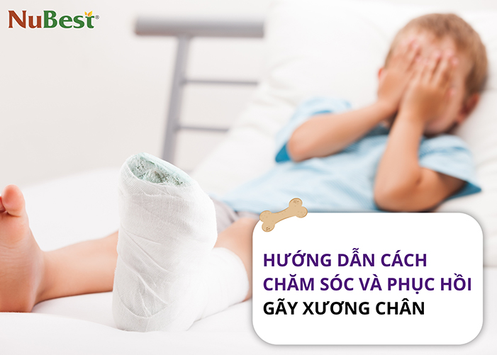 Cách phục hồi gãy xương chân nhanh chóng và hiệu quả cho trẻ