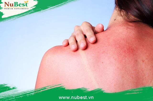 Cháy nắng khiến da bị tổn thương theo từng mức độ khác nhau