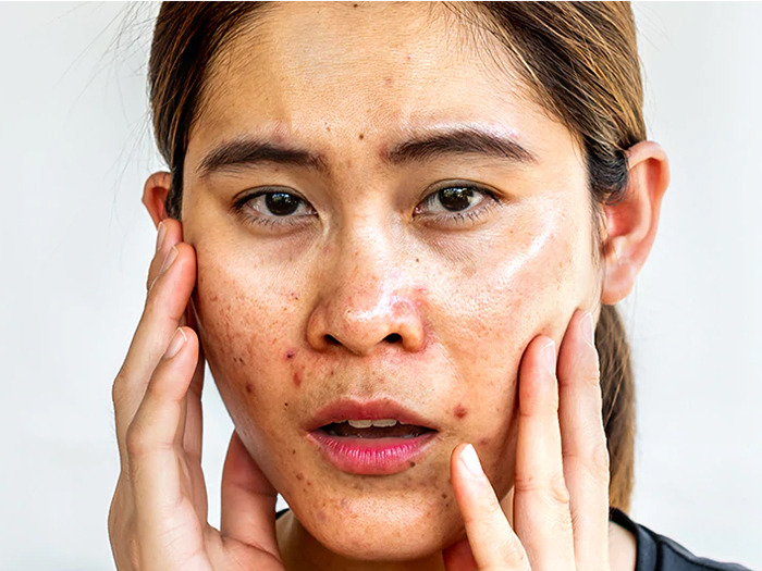 Da nhờn là một trường lý tưởng để các vi khuẩn gây mụn phát triển