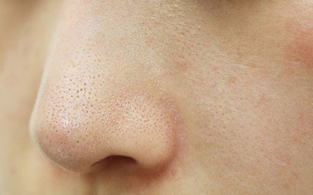 Làm thế nào để những nốt mụn cám trên khuôn mặt bạn được cải thiện?