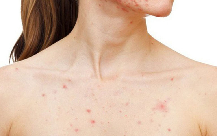 Mụn nang thường mọc thành từng mảng, có nhân mụn và mảng mụn màu đỏ