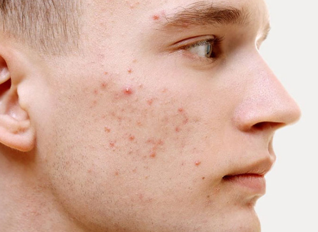 Mụn trứng cá là mụn thể nhẹ, dễ điều trị