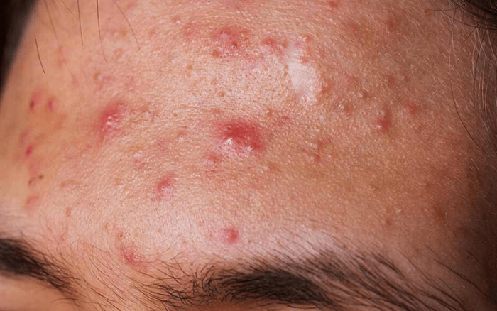 Mụn viêm đỏ không nhân là loại mụn trứng cá nặng, khó điều trị