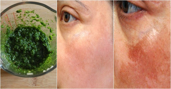 Lá mồng tơi là nguyên liệu trị nám da rất quen thuộc với chị em phụ nữ Việt