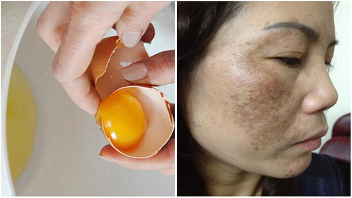 Trị nám bằng trứng gà sau 6-8 tuần sẽ nhìn thấy hiệu quả