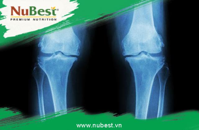 Chụp X-quang xương chân có thể xác định được tình trạng tấm tăng trưởng